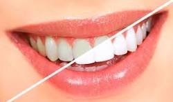 Teeth Whitening
